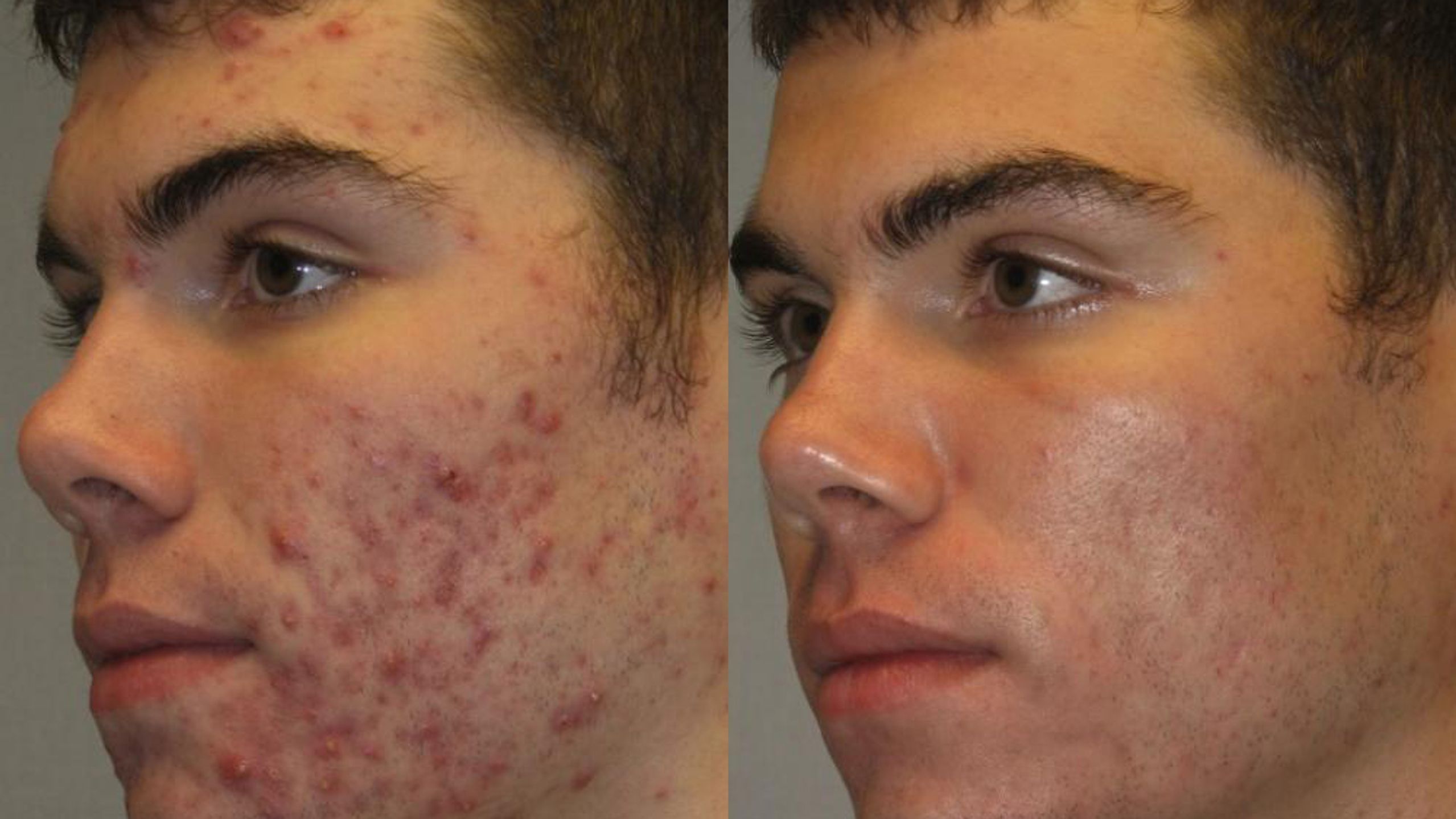 Adults Keeping a Steady Acne Routine Without Panic Buying