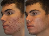 Adults Keeping a Steady Acne Routine Without Panic Buying