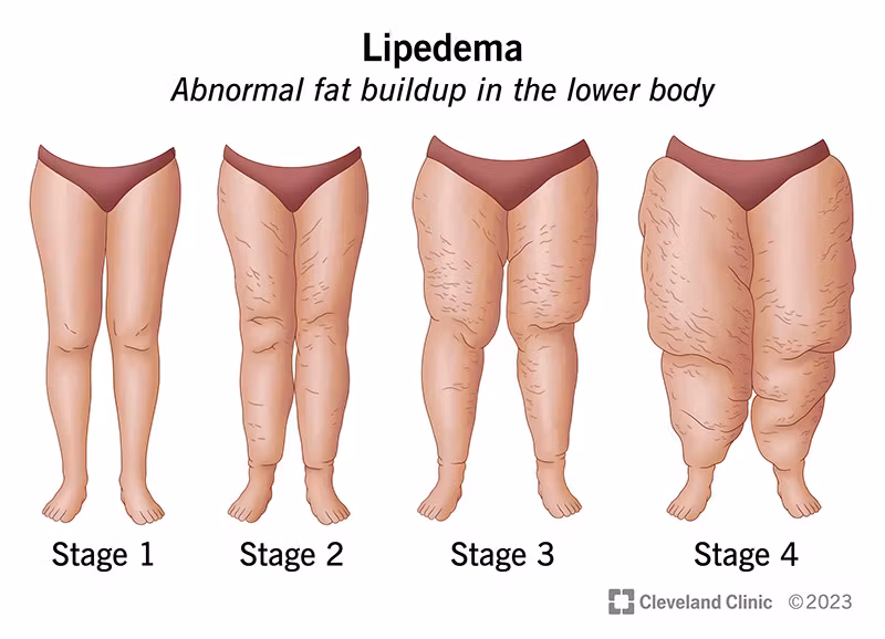 TH Consult: Lipodema course