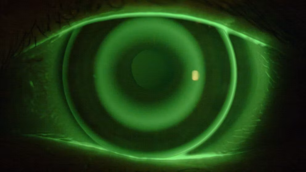 Push for Myopia Progression