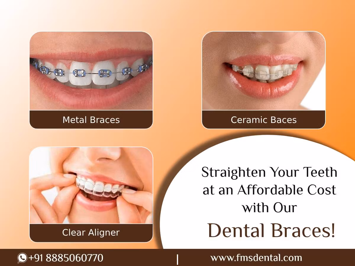 Dental Braces