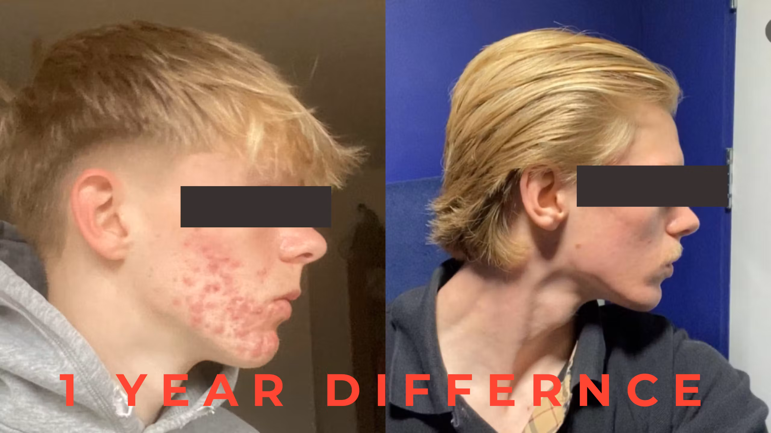 The Clear Skin Method