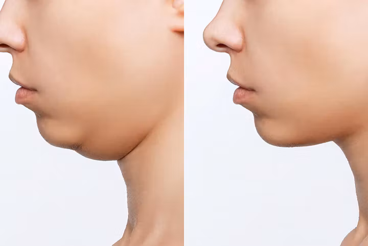 The Double Chin Solution