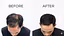 Men Over 40 Hair Recovery